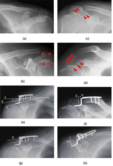 Posterior Positioning of a Clavicle Hook Plate Is a Risk Factor for ...