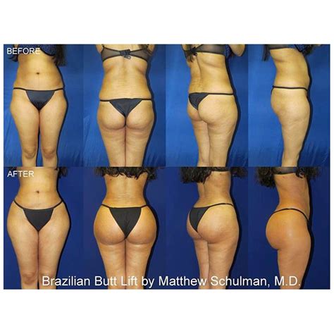 Bbl Surgery, Mommy Makeover, Tiny Waist, Tummy Tucks, Liposuction, Body ...