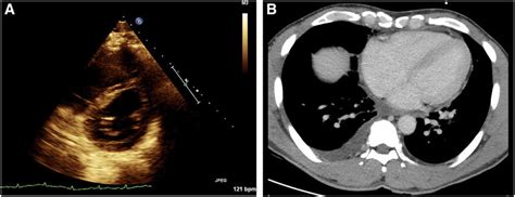 Case 2: (A) Echocardiogram exhibiting "D sign" of the interventricular... | Download Scientific ...