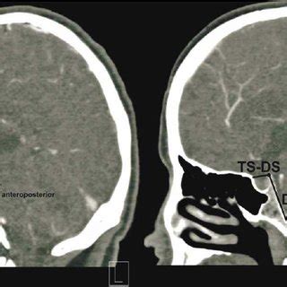 The distance between the tuberculum sellae and dorsum sellae (TS–DS),... | Download Scientific ...