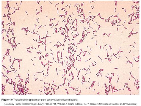 Actinomyces treatment antibiotics