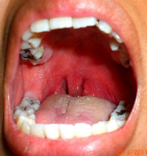 Phimaimedicine: 1,064. Peritonsillar abscess-Quinsy