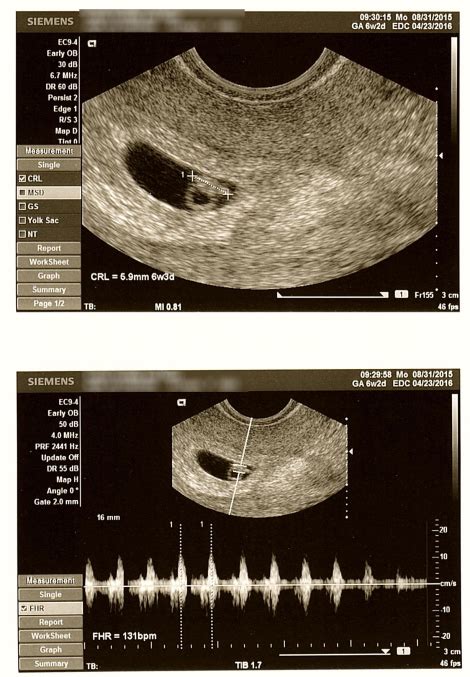 6 Week Ultrasound Heartbeat