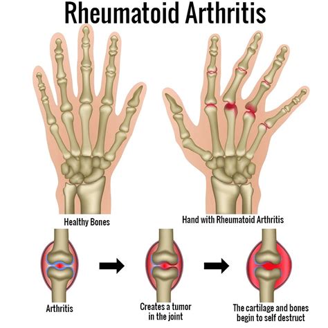 Rheumatoid Arthritis - Causes, Signs, Symptoms, Diet, Treatment