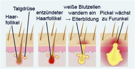 Boils: treatment, symptoms, prognosis