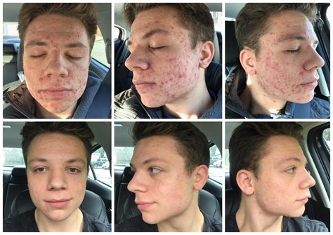 Before and after 4 months of accutane 🙂🙂 : r/Accutane