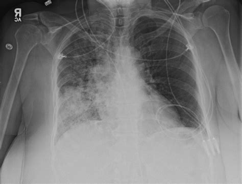 Differential Diagnosis of Hemoptysis