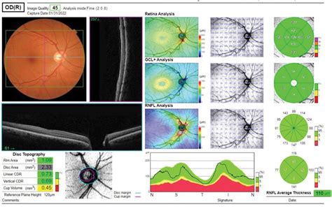 Vertical C/D Ratio Can Help Monitor Non-glaucomatous Eyes