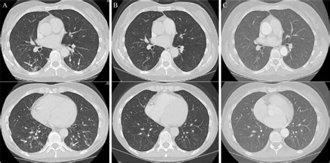 A-C. Patient's CT scan of the chest with contrast depicting satellite ...