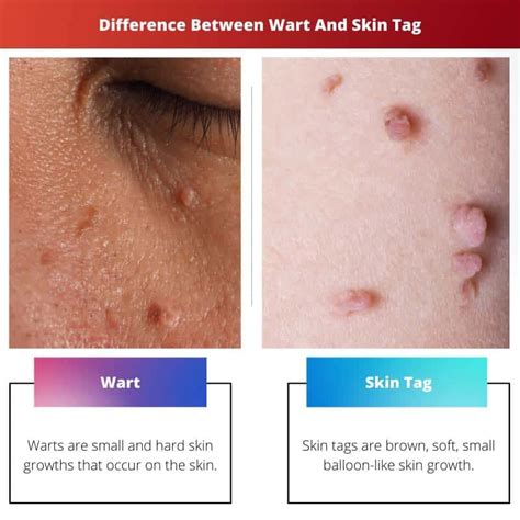 Wart vs Skin Tag: Difference and Comparison