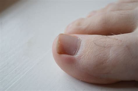 Toenail Problems: Ingrown Toenail, Toenail Fungus, More