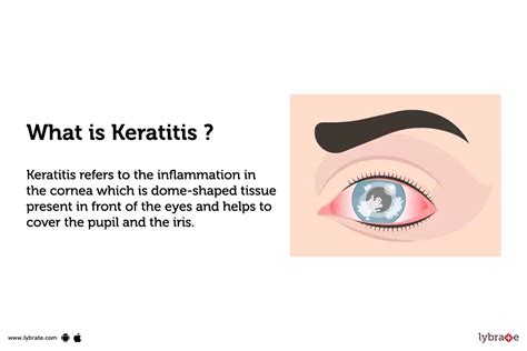 Keratitis: Treatment, Procedure, Cost, Recovery, Side Effects And More