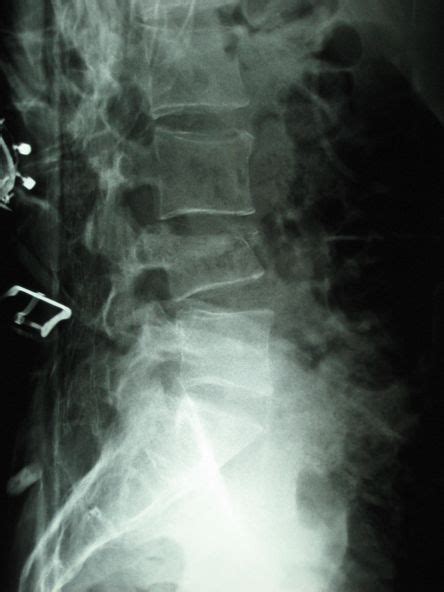 Lumbar Compression Fracture - Physiopedia