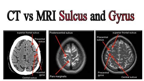 CT VS MRI Sulcus and Gyrus - YouTube