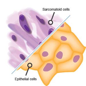 Biphasic Mesothelioma - Diagnosis, Treatment and Prognosis