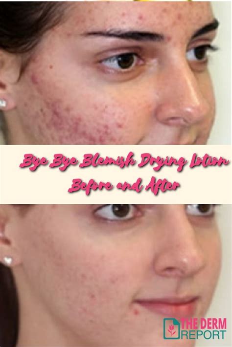 Bye Bye Blemish Drying Lotion Review | Pimple & Acne Spot Treatment ...