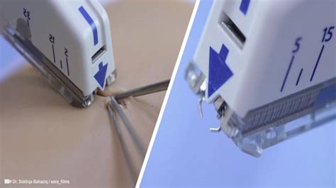 Surgical Skin Stapler: Take a Close Look at How It Works? – EndoGynecology