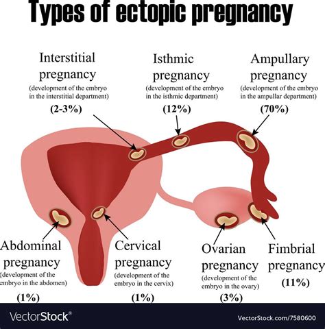 types of pregnancy - Google Search | Pregnancy development, Ectopic ...