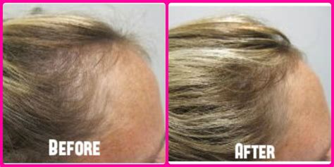 Vitamins Hair Loss, List to Help Restore Female Hair Thinning