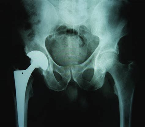 Pain near artificial hip should be evaluated without delay | Honolulu ...