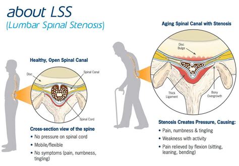 Mild® Procedure - Asheville, NC: Premier Pain Solutions