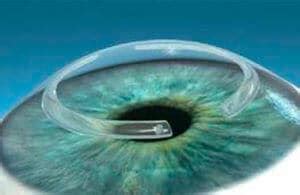 Keratoconus Treatment New Jersey | Intacs New Jersey | CLEI