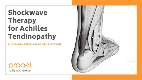 Shockwave Therapy for Achilles Tendinopathy - Propel Physiotherapy