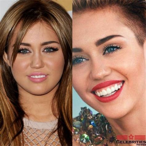 Top 21 Celebrities Before and After Veneers And Celebrity Cosmetic Dentistry | Celebrities Newss