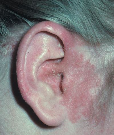 Rash around ear | MDedge Family Medicine