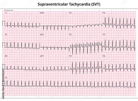 ECG Supraventricular Tachycardia - 12 Leads ECG Paper Stock Vector | Adobe Stock