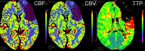 Perfusion Primer | neuroangio.org