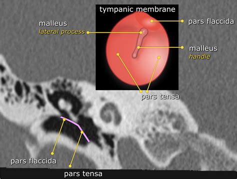 The Radiology Assistant : Temporal bone - Anatomy 2.0