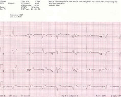 PediCardiology Quiz Answers: Quiz #5 Answers: WPW syndrome