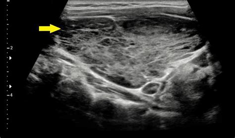 Primary Thyroid Lymphoma in an Adolescent with Hashimoto’s Thyroiditis ...