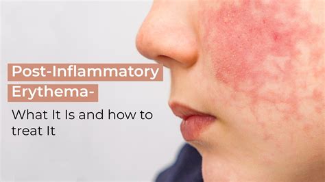 Post-Inflammatory Erythema: What It Is and How to Treat It - Suganda ...