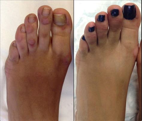 Cosmetic Foot Surgery- Harley Street, London - 0207 870 1076