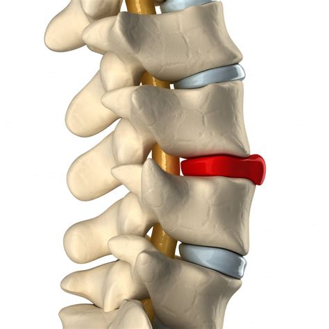 What’s The Difference Between a Herniated Disc and a Bulging Disc?