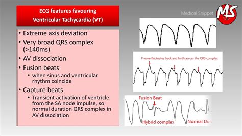 Ventricular Tachycardia Vs Ventricular Fibrillation