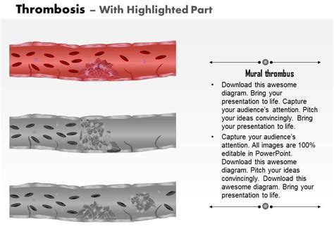 0814 Types Of Thrombosis Medical Images For Powerpoint | Presentation ...