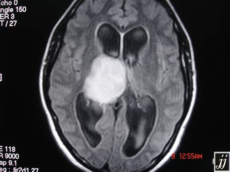 astrocytoma – Radiopaedia