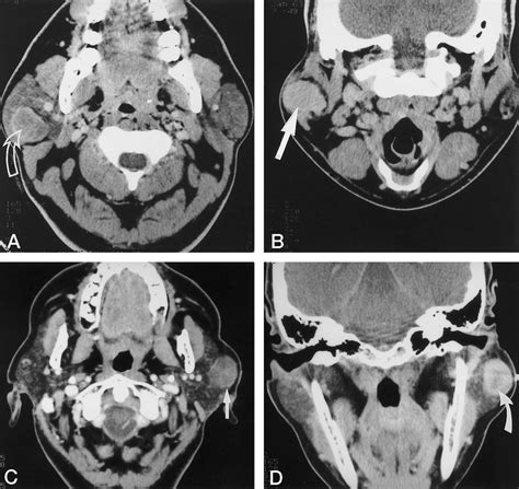 A, Axial CT scan of a typical parotid pleomorphic adenoma, obtained 7 ...