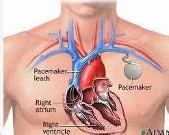 Pacemaker Surgery in India