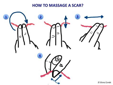 How to massage a scar - Elena Conde