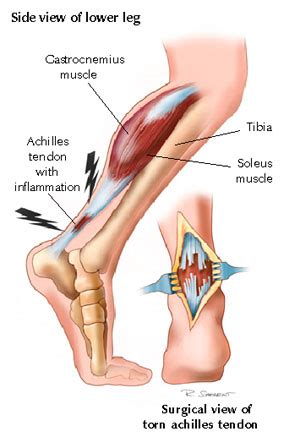 Achilles Rupture - Physiopedia