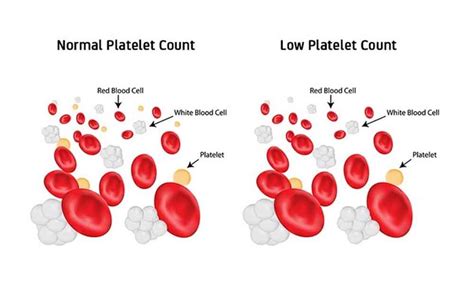 How to Increase a Low Platelet Count - Anti Leukemia