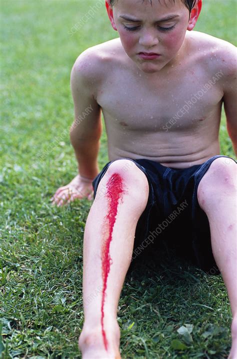 Bleeding knee - Stock Image - M330/0925 - Science Photo Library