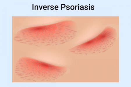 How to Prevent & Treat Inverse Psoriasis - eMediHealth