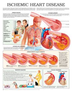 Ischemic heart disease – Anejo