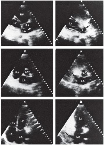 Shunt Detection and Quantification | Thoracic Key