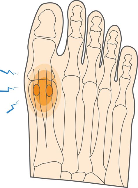 What is Sesamoiditis & How to Relieve Ball of Foot Pain? - Upswing Health